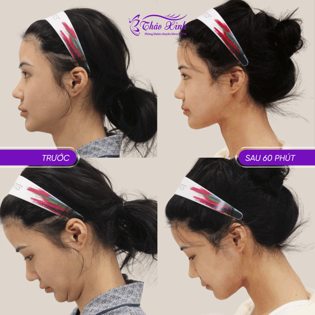 Lấy Mỡ Nọng Cằm 6