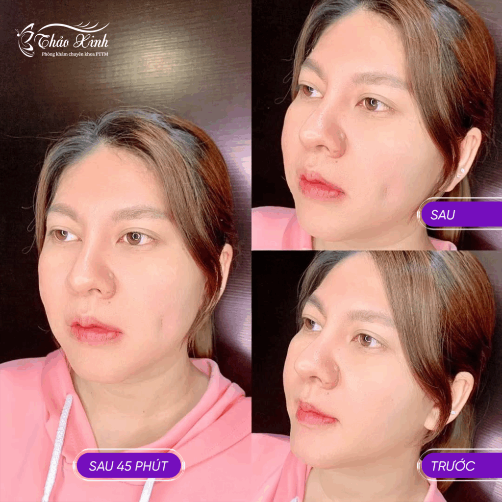 Tạo Má Lúm Đồng Tiền 6