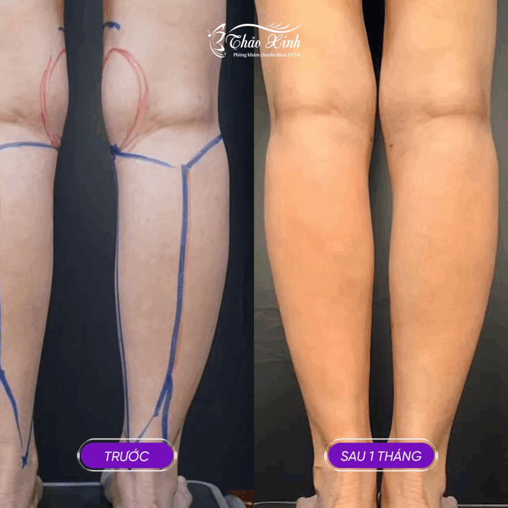 Hút Mỗ Vùng Bắp Chân 6