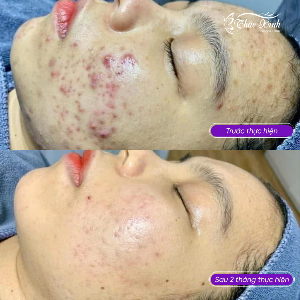 Điều Trị Mụn Trứng Cá 7