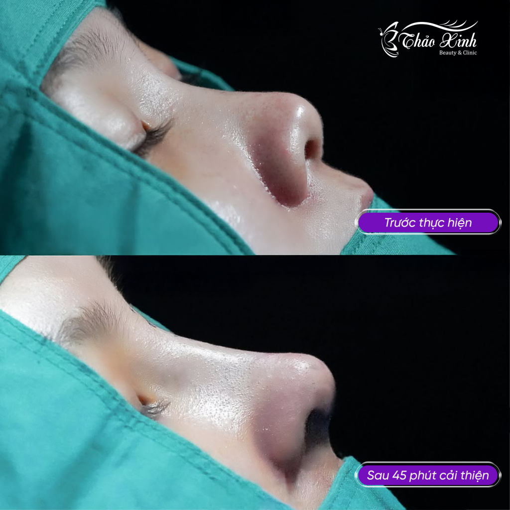 Nâng Mũi Sụn Hàn Quốc 5