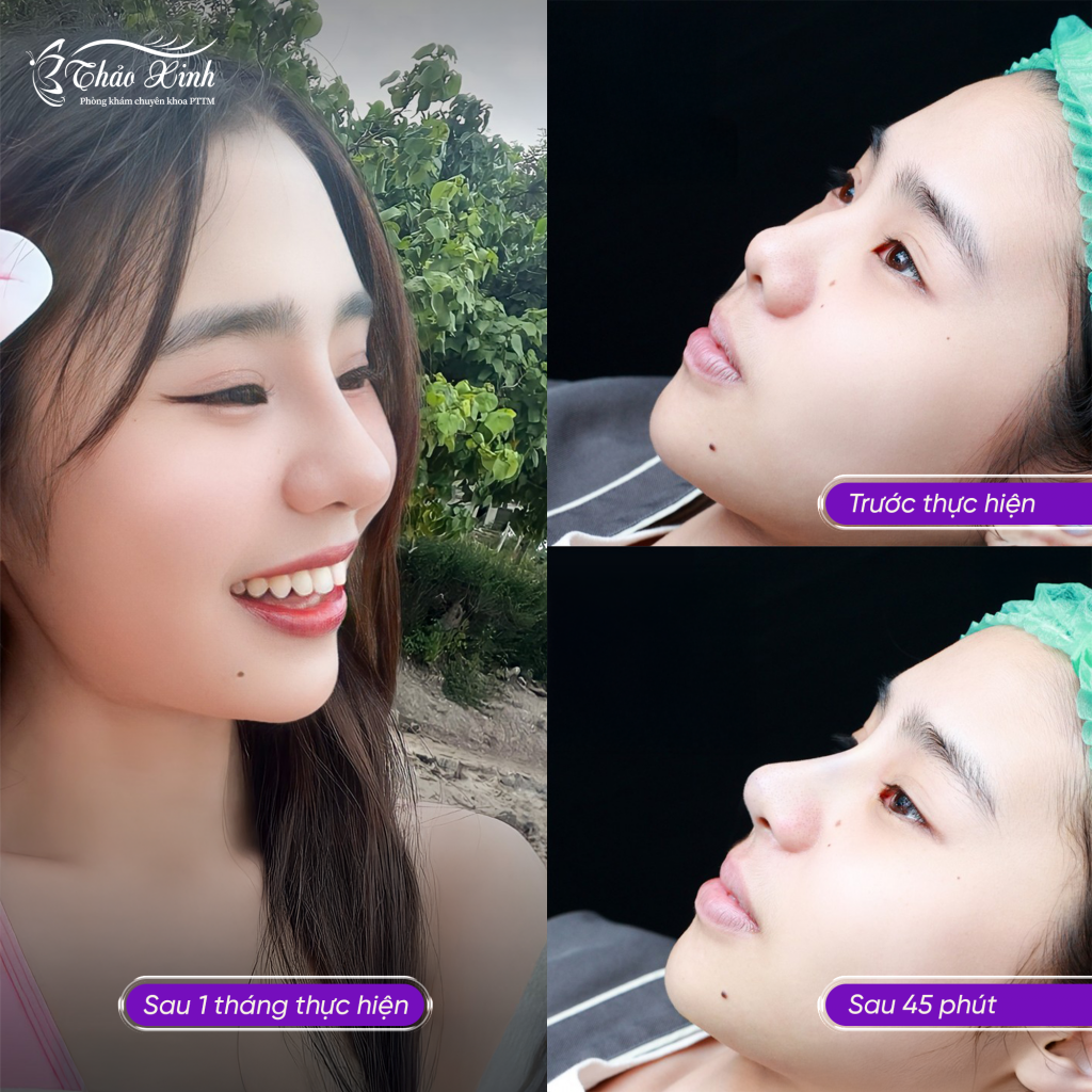 Nâng Mũi Sụn Surgiform 4