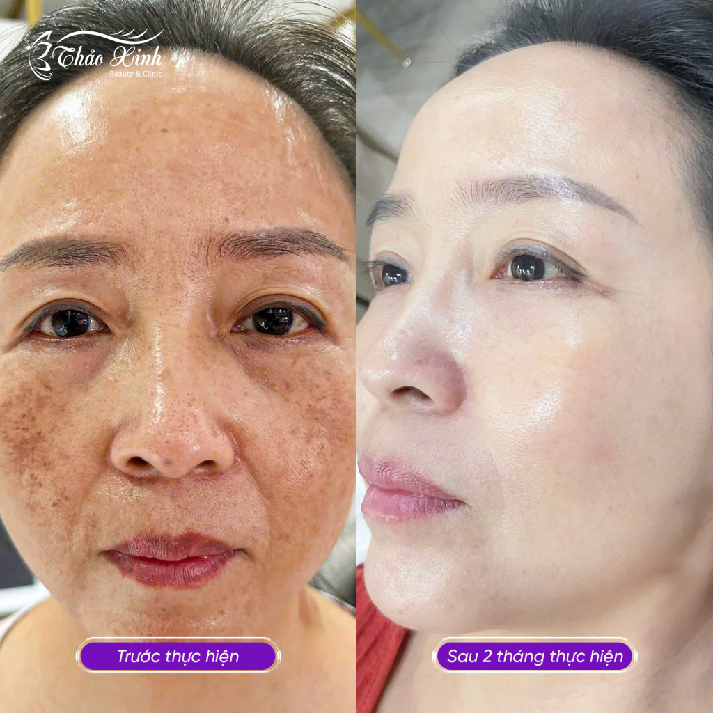 Điều Trị Nám Mảng 4