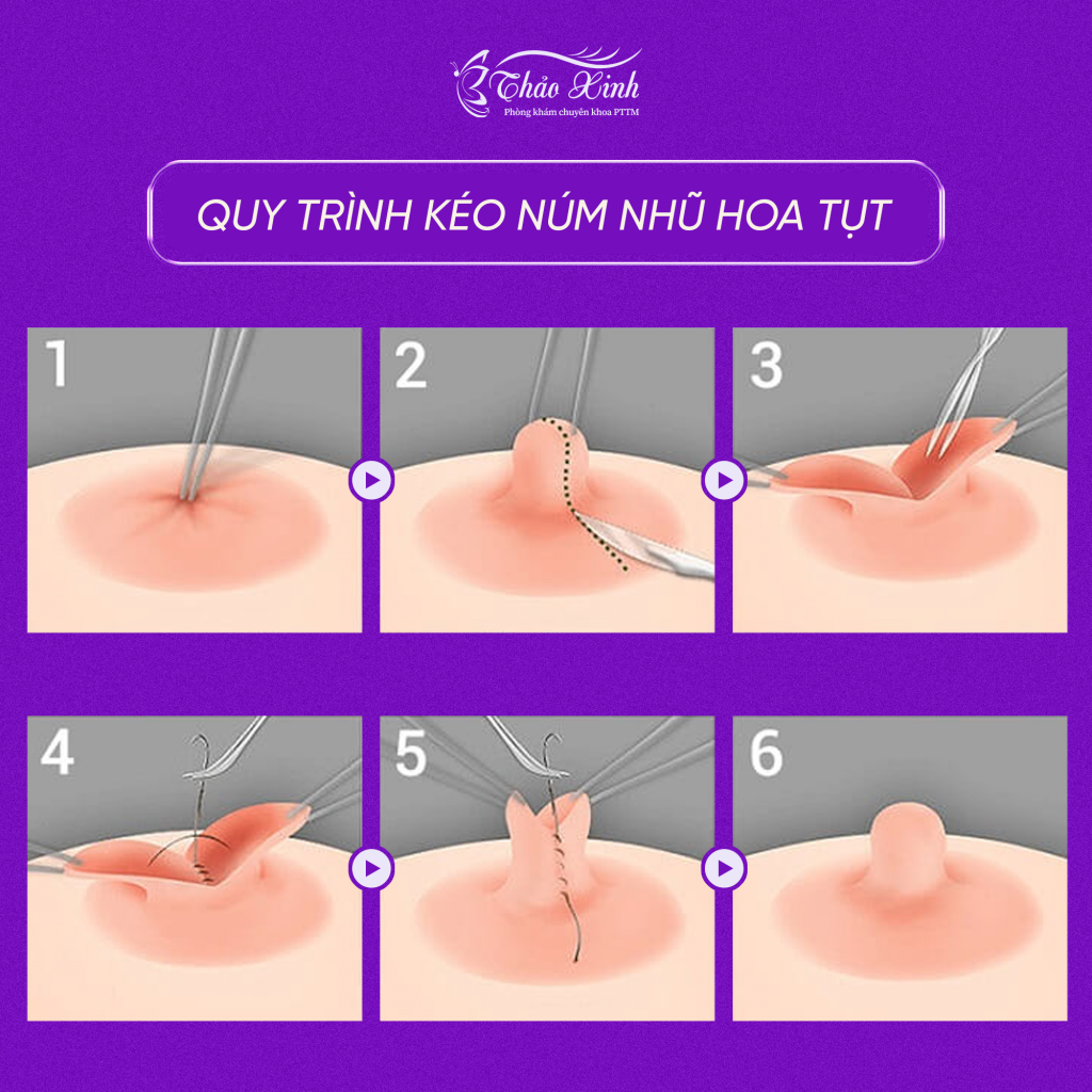 Phẫu Thuật Tạo Hình Đầu Ngực 7