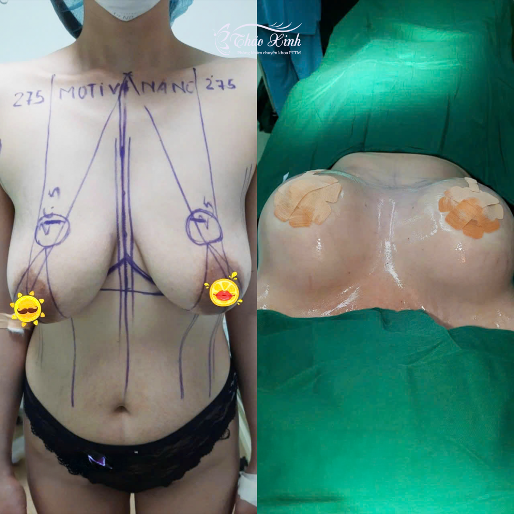Thu Nhỏ Quầng/Đầu Ngực 7