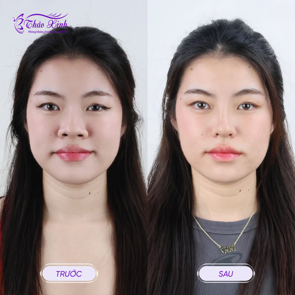 Thu Gọn Cánh Mũi “Cuộn + Cắt” 5