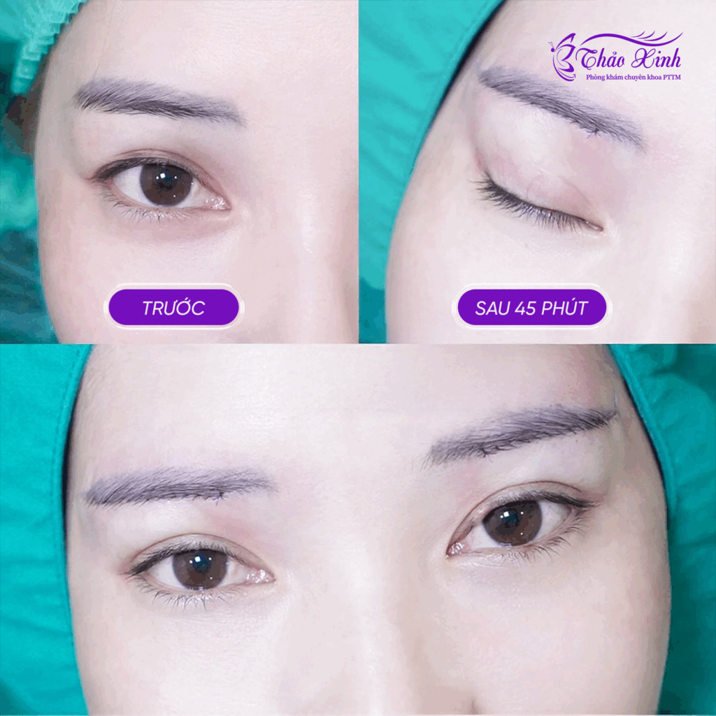 Nâng Cung Mày Rút Chỉ 5