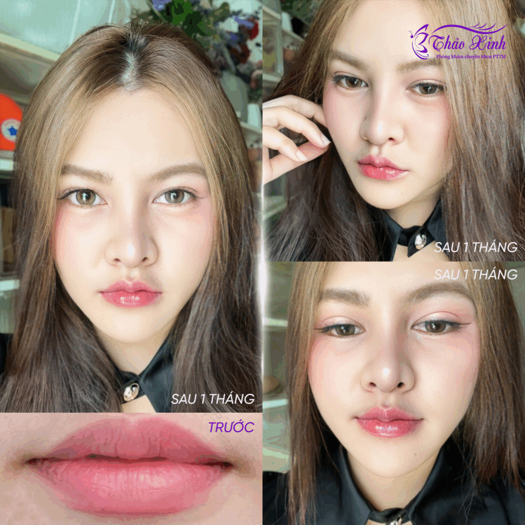 Tạo Hình Môi Trên 5