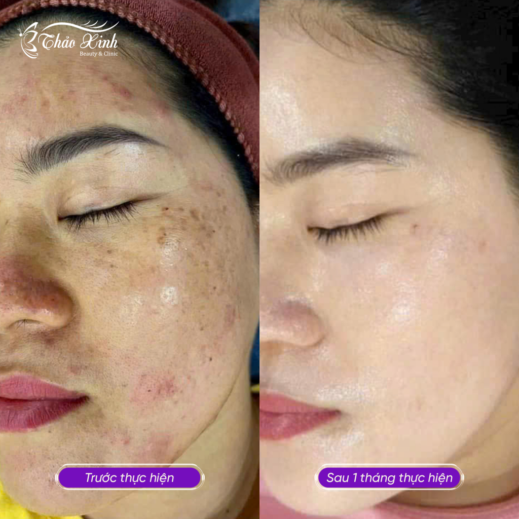Điều Trị Nám Đốm "Bớt Hori" 5