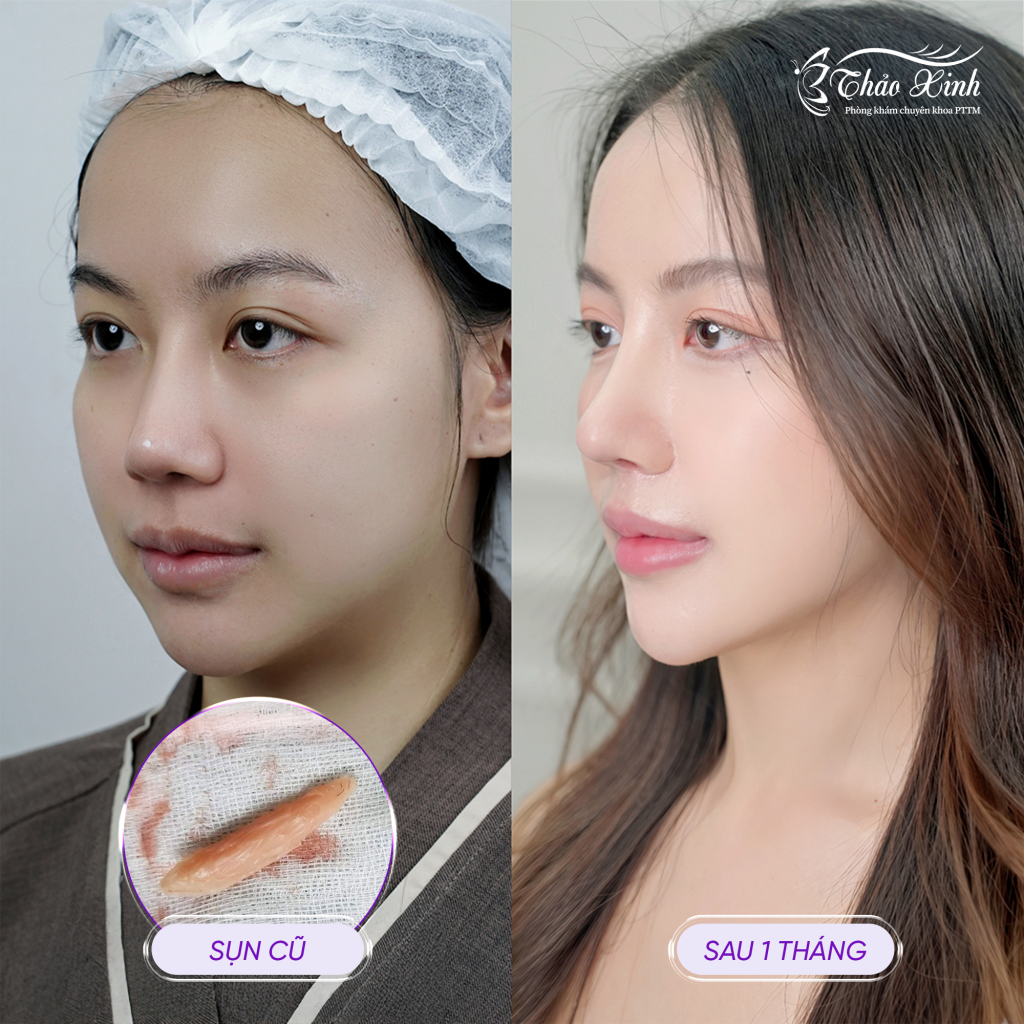 Lấy Sụn Mũi Cũ 4