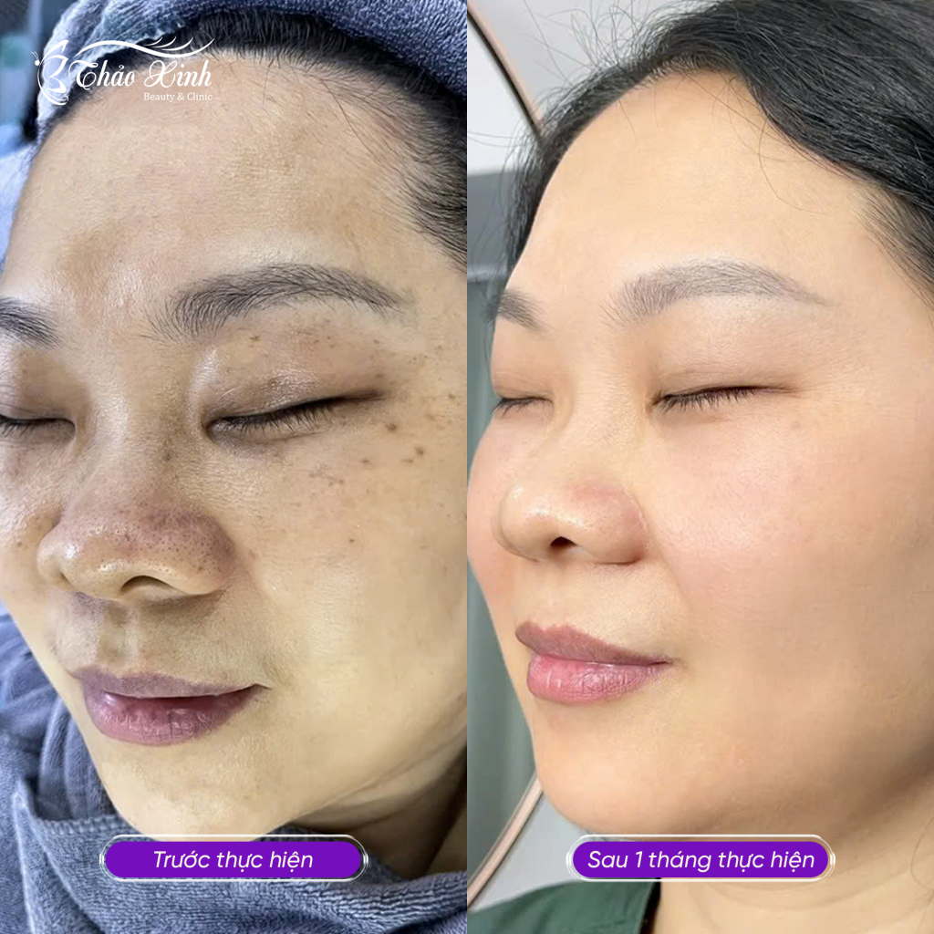 Điều Trị Nám Tổng Hợp 7
