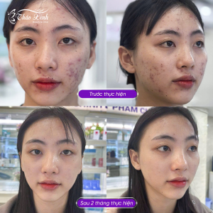Điều Trị Mụn Thâm 24