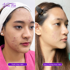 Điều Trị Mụn Dậy Thì 19