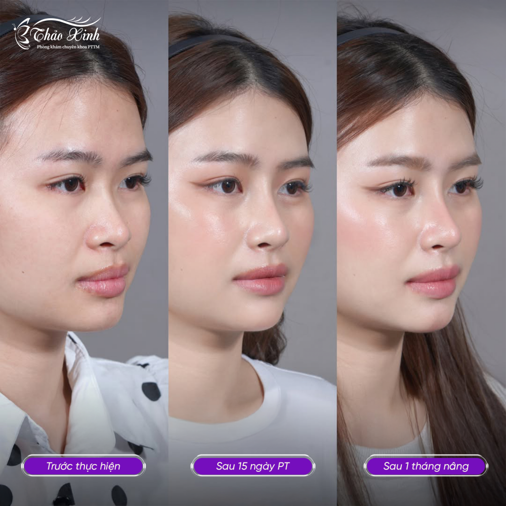 Nâng Mũi Bán Cấu Trúc 5