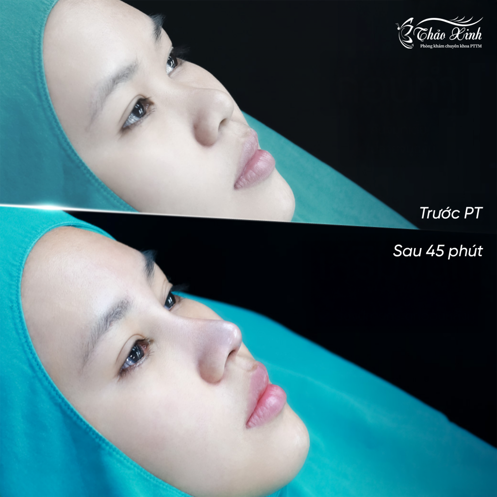 Nâng Mũi Cấu Trúc Kín 5
