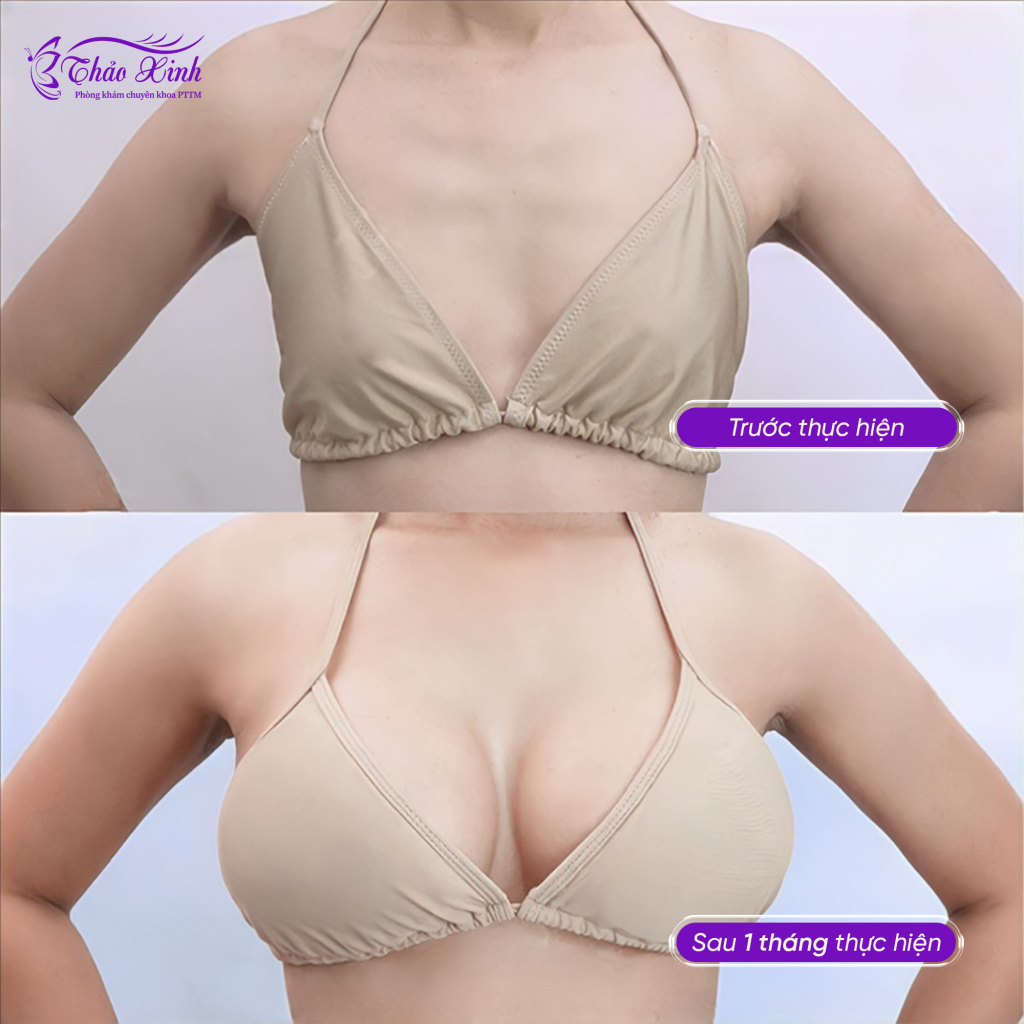 Nâng Ngực Túi Trơn 3