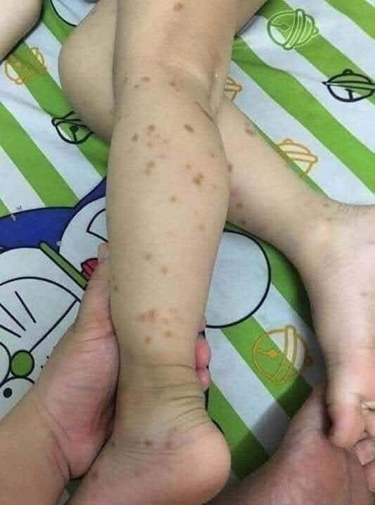 Điều Trị Thâm Chân 6