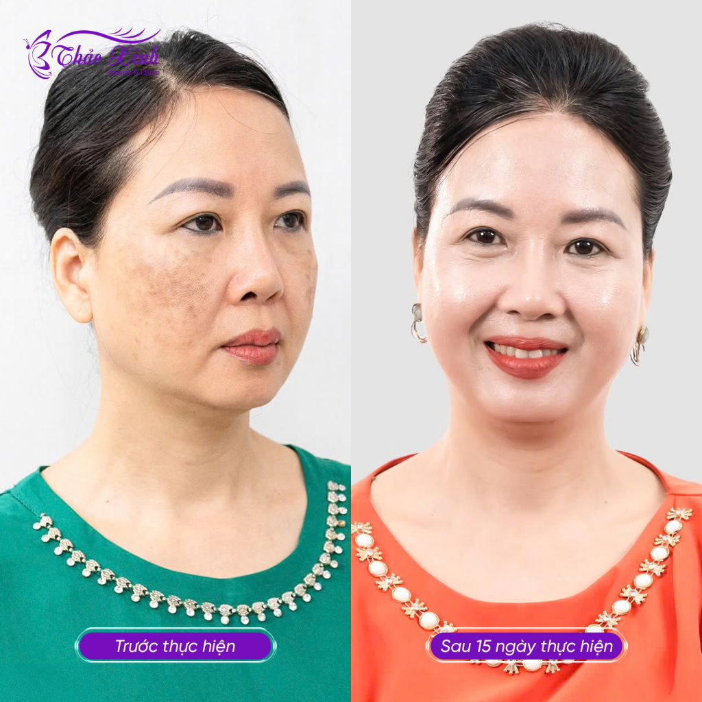 Điều Trị Nám Tổng Hợp 6
