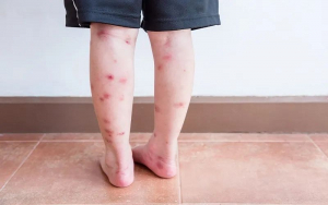 Điều Trị Thâm Chân 14