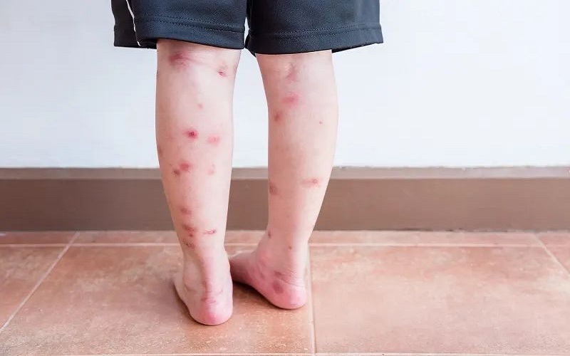 Điều Trị Thâm Chân 5