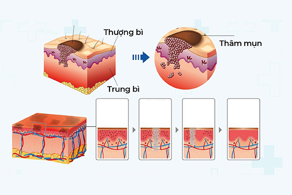 Điều Trị Thâm Mụn Lưng 5