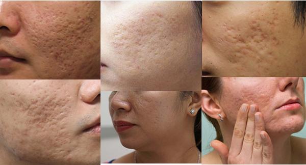 Điều Trị Sẹo Rỗ 4