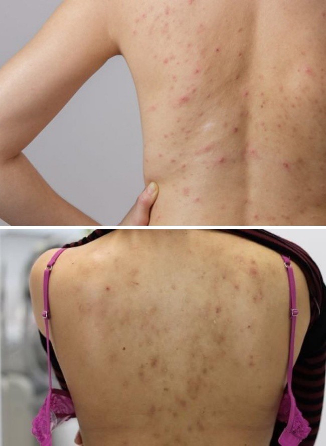Điều Trị Thâm Mụn Lưng 7