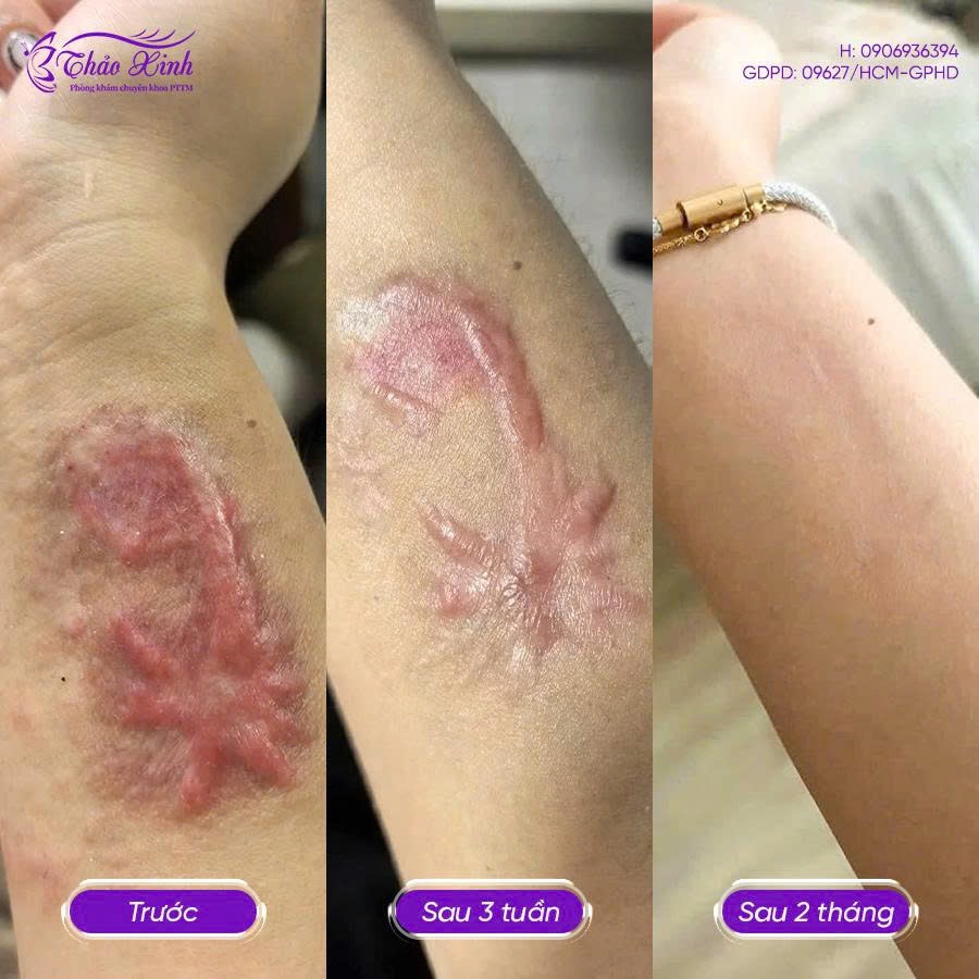 Điều Trị Sẹo Bỏng 3