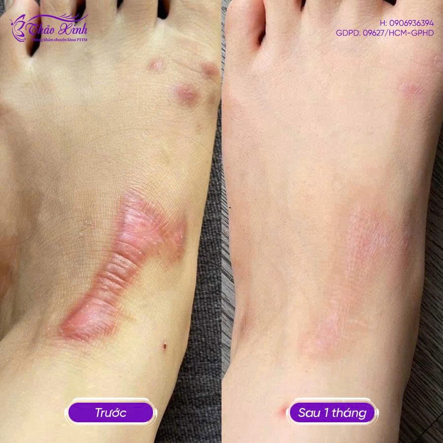 Điều Trị Sẹo Bỏng 4