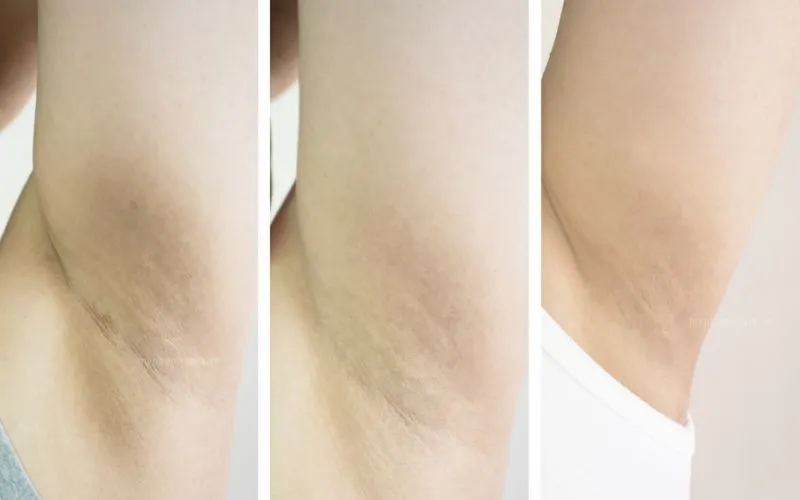 Điều Trị Thâm Nách 4