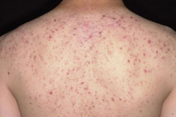 Điều Trị Thâm Mụn Lưng 7