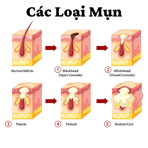 Điều Trị Thâm Mụn Lưng 8