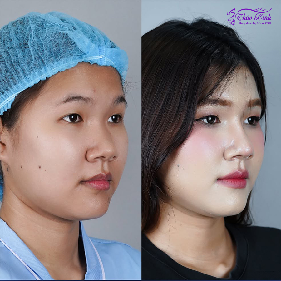 Nâng Mũi Sụn Mỹ 3
