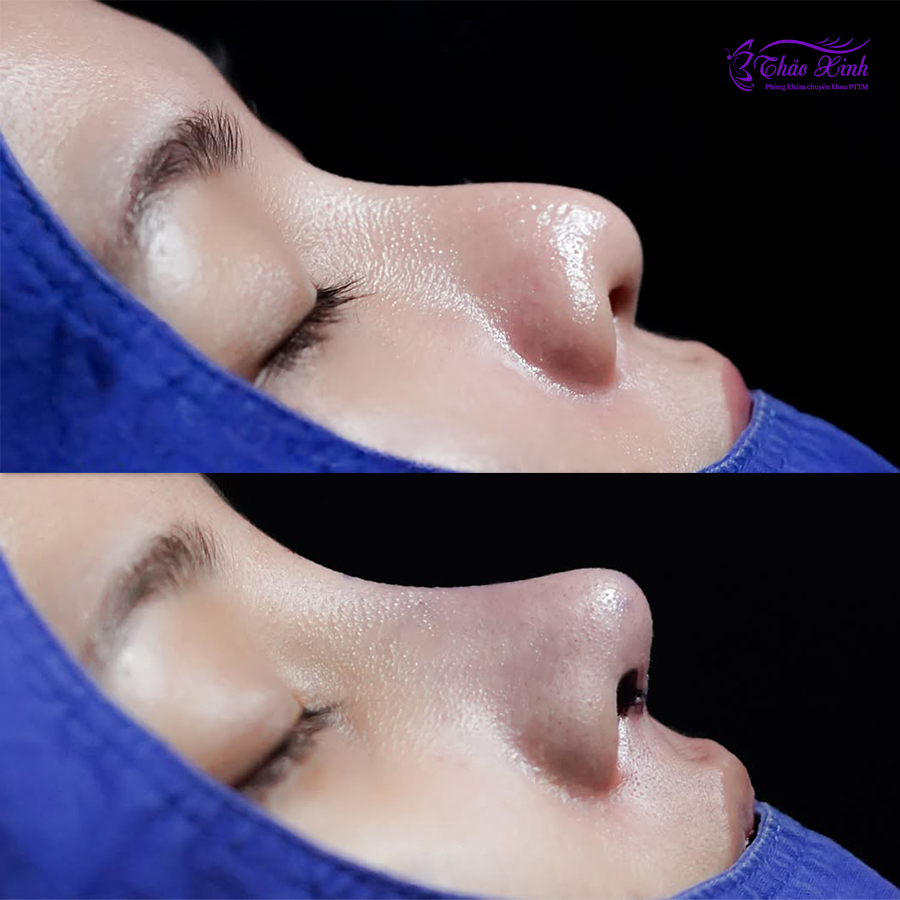 Nâng Mũi Sụn Mỹ 4