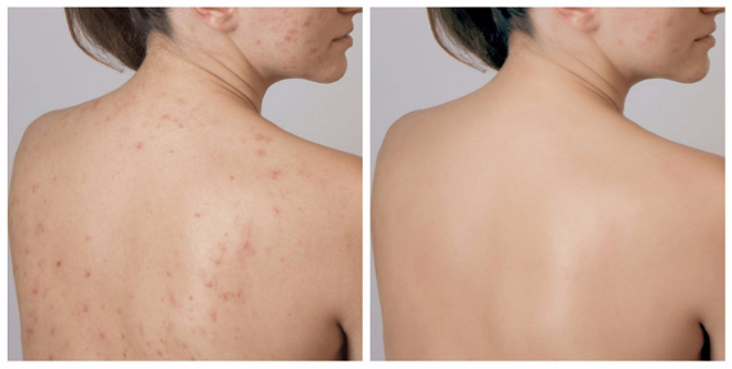 Điều Trị Thâm Mụn Lưng 6