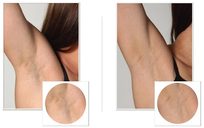 Điều Trị Thâm Nách 5