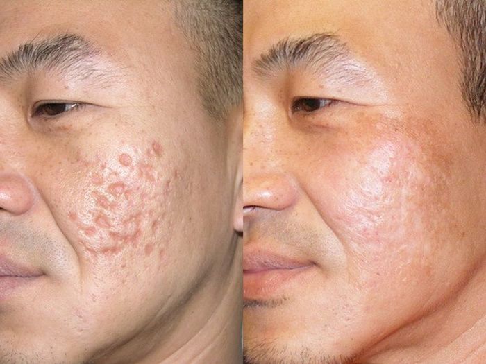 Điều Trị Sẹo Rỗ 6