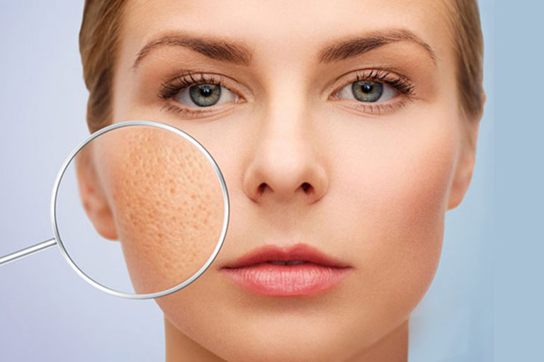 Điều Trị Sẹo Lõm 6