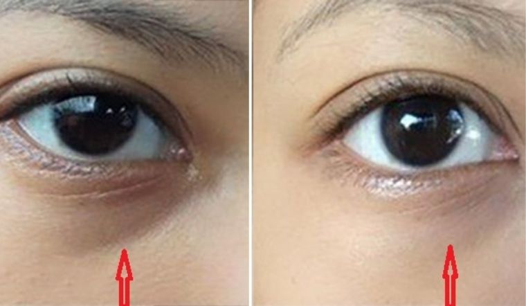 Điều Trị Thâm Mắt 7