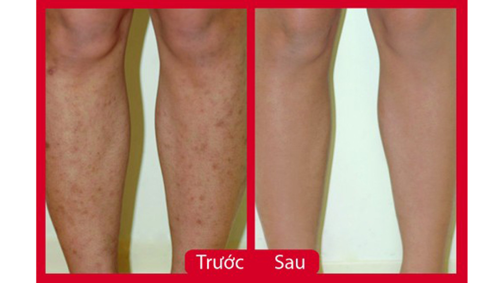 Điều Trị Thâm Chân 4