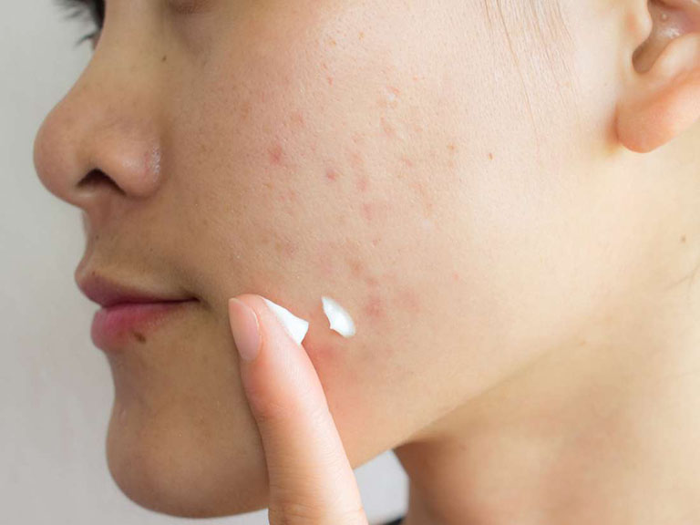 Điều Trị Sẹo Lõm 8